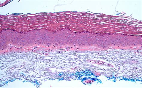 Clear Cell Acanthoma Histology