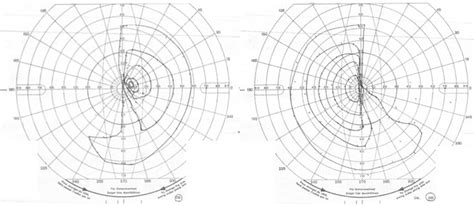 Vision test. Formal Goldmann visual field testing revealed a bitemporal... | Download Scientific ...