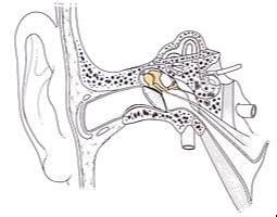 Stapedectomy