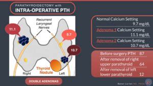 Parathyroidectomy with intra-operative PTH double adenomas - Hyperparathyroidism Surgery - Dr ...