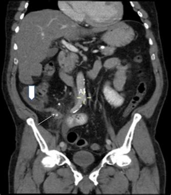 Normal Ct Scan Abdomen