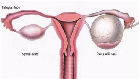 Ovarian Cyst Types - Symptoms, Pain, Diagnosis & Treatment