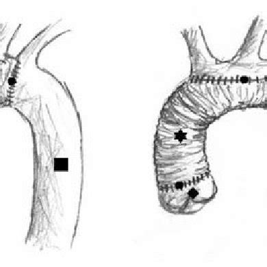 Aortic arch replacement. From left to right: implant replacing... | Download Scientific Diagram