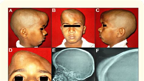 (A, B, C, D) A 11 year old male patient with a large dome-shaped, bony... | Download Scientific ...