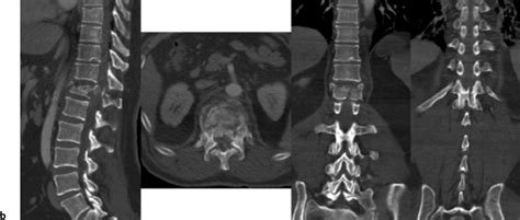 Burst Fracture Treatment | Neupsy Key