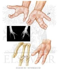 Explain Congenital Hand Deformities - Assignment Point