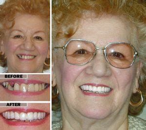 Implant Supported Dentures | Brooklyn Cosmetic Dentistry