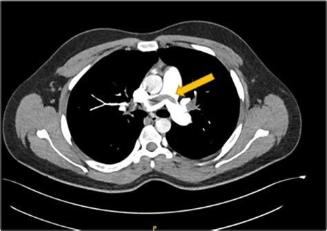 CTA chest axial view showing the saddle thrombus (arrow) at the ...