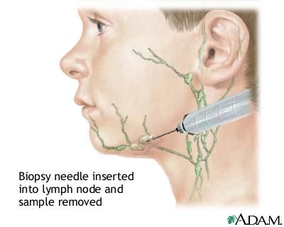 Lymph node culture: MedlinePlus Medical Encyclopedia Image