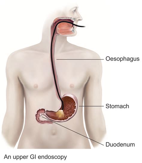 Upper-GI-endoscopy-procedure-diagram | Exeter Gut Clinic