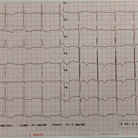 ECG showing ventricular bigeminy. | Download Scientific Diagram