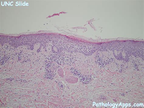 spongiotic dermatitis skin histology