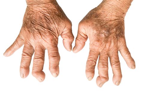 Wide Variation in Characteristics of Difficult-to-Treat Rheumatoid Arthritis - Rheumatology Advisor