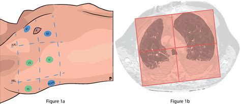 Lung Ultrasound And The Blue Protocol Crashing Patien - vrogue.co