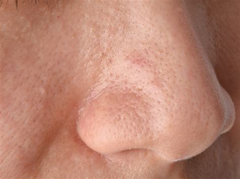 How To Tighten Pores On Nose / How To Shrink Large Pores On Nose Overnight Large Pores On Nose ...