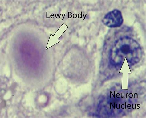 What is Lewy Body Dementia - Causes, Symptoms, Diagnosis, Treatments