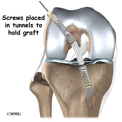 ACL Hamstring Tendon Graft Reconstruction - eOrthopod.com