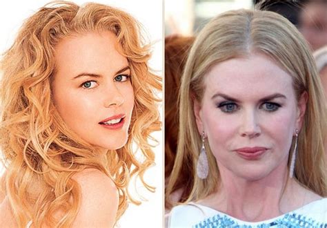 Nicole Kidman plastic surgery for puffy look