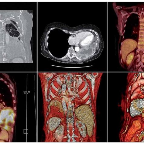 (PDF) Sarcomatoid Carcinoma of the Lung – a Case Report