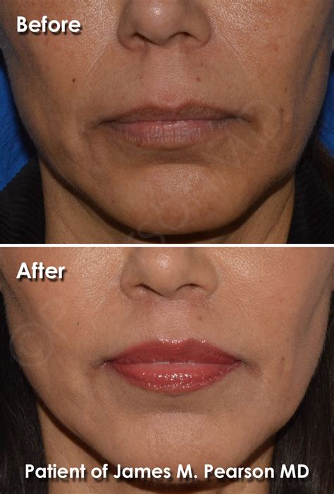 Lip Lift - Dr. James Pearson Facial Plastic Surgery