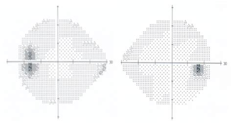 Humphrey visual field testing (24-2) shows enlarged blind spot in the... | Download Scientific ...