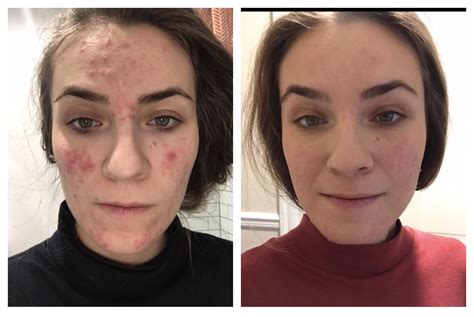 One week on Azelaic Acid : r/Rosacea