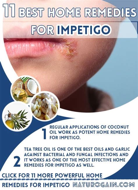 What Is the Best Cream for Impetigo - Dominik-has-Mayer