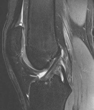 MRI for Anterior Cruciate Ligament Injury: Overview, Anatomy, Mechanism of Injury