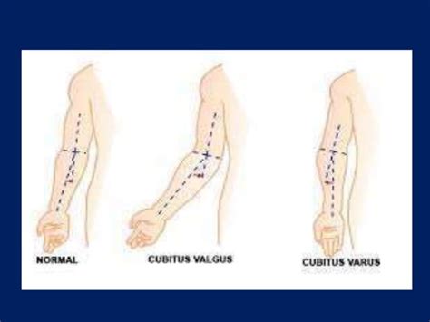 Cubitus varus deformity