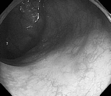 Colonoscopy image showing the colonic scar five months later ...