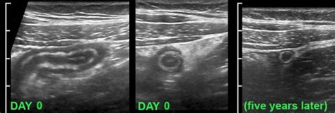 The Radiology Assistant : Appendicitis - US findings