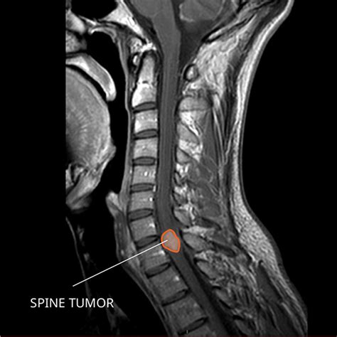 Ependymoma - National Cancer Institute