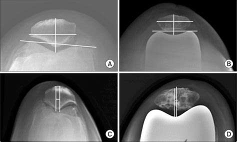 Radiographic analysis of the patellar skyline view showing pre­ and ...