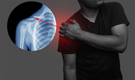 Best Shoulder Surgery in Jaipur - Khandaka Hospital