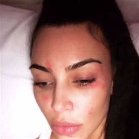 Extra - Kim Kardashian Reveals Her Psoriasis Outbreak