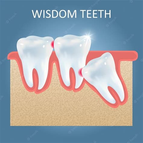Wisdom Tooth Extraction – Best Dentist In Baner