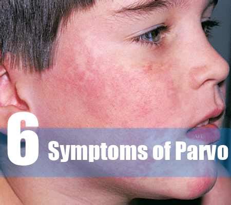 6 Common Symptoms of Parvo – Natural Home Remedies & Supplements