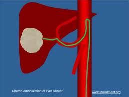 Chemoembolization (trans-arterial chemoembolization or TACE):Knowledge Cancer