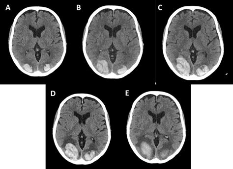 Intraparenchymal hemorrhage with occipital pattern in our patient, at... | Download Scientific ...