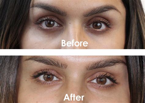 Dark Under Eye Circles - The Skiny