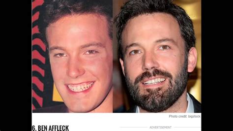 10 Celebs with Fake Teeth - Before After Pics - YouTube