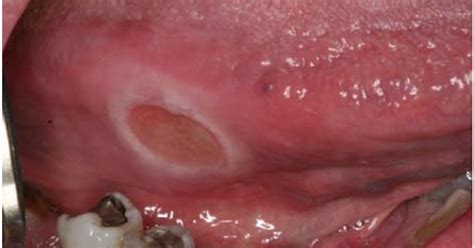 Study Medical Photos: Description Of Mouth Ulcers With Pictures For ...