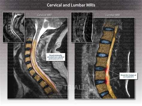 Cervical and Lumbar MRIs - Trial Exhibits Inc.