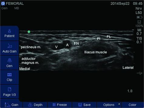 Ultrasound-guided femoral nerve block | Anesthesia Key