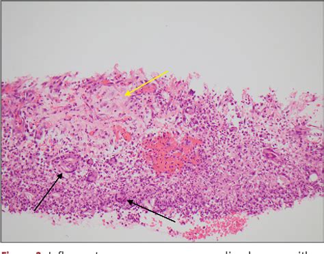 Figure 1 from Vernix Caseosa Peritonitis Causing Acute Abdomen After ...