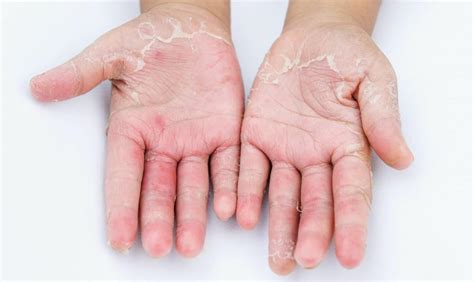 Symptoms of Contact Dermatitis: Ulrike Ziegner, MD, PhD: Allergist