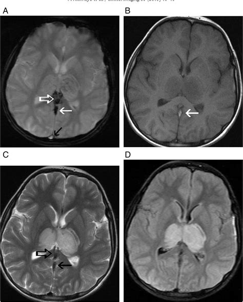 Diagnostic value of T2*-weighted gradient-echo MRI for segmental ...