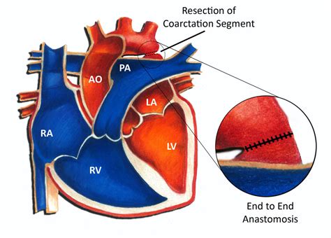 Coarctation of the Aorta - Surgery - Pediatric Heart Specialists