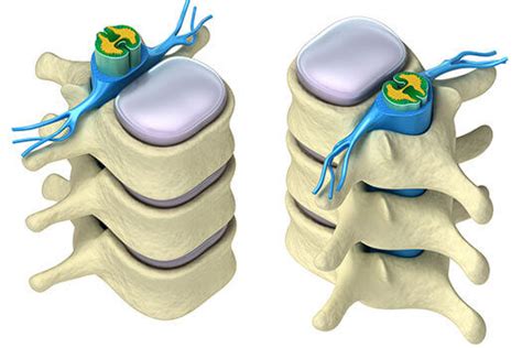 Understanding Neurogenic Claudication