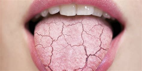 How does Dry Mouth affect your oral and overall body health?